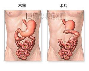 排尿困难病症分类 胃窦炎 胃窦炎-简介，胃窦炎-病症分类