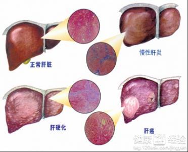 肝硬化结节是什么 肝硬化结节的原因有什么