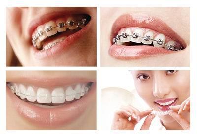 牙齿矫正隐形牙套 牙齿矫正器 牙齿矫正器-隐形牙套优缺点，牙齿矫正器-注意