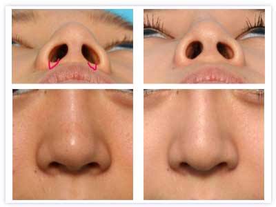 鼻孔缩小手术 鼻孔缩小手术 鼻孔缩小手术-简介，鼻孔缩小手术-手术方式