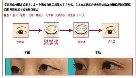 做眼袋修复术 眼袋修复术 眼袋修复术-概述，眼袋修复术-类型