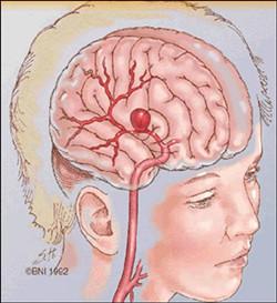 脑动脉瘤早期症状 脑动脉瘤 脑动脉瘤-简介，脑动脉瘤-主要症状