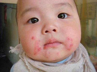 婴儿湿疹最佳治疗方法 婴儿长湿疹怎么办