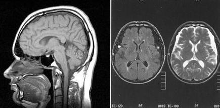 核磁共振mri MRI MRI-简介，MRI-核磁共振成像原理