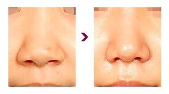 鼻尖塑形美容手术 鼻尖塑形术 鼻尖塑形术-介绍，鼻尖塑形术-手术过程