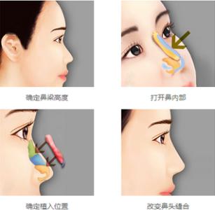 自体组织移植隆鼻 自体组织隆鼻 自体组织隆鼻-基本介绍，自体组织隆鼻-常用材料