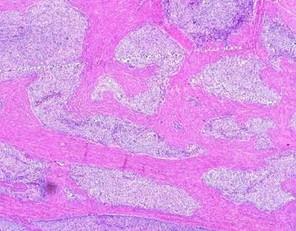 子宫内膜样腺癌 子宫内膜腺癌 子宫内膜腺癌-症状体征，子宫内膜腺癌-病理变化