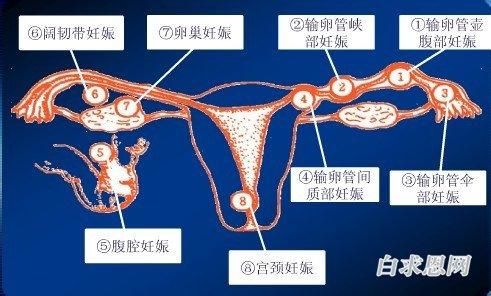 异位妊娠的临床表现 卵巢妊娠 卵巢妊娠-病因，卵巢妊娠-临床表现