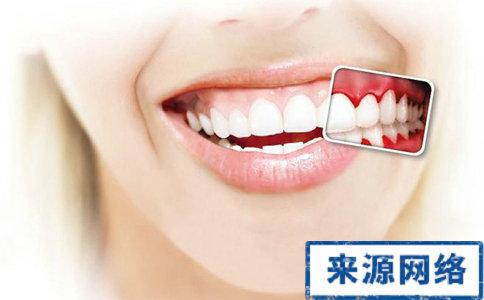 牙龈炎临床表现有 牙龈炎 牙龈炎-临床表现，牙龈炎-诊断