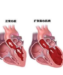心肌炎后遗症 心肌炎后遗症 心肌炎后遗症-1概述，心肌炎后遗症-2心肌炎后遗症