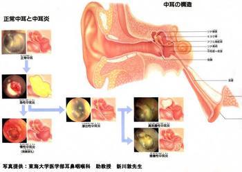 中耳炎病因 中耳炎 中耳炎-概述，中耳炎-病因