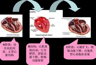 心衰的临床表现 心衰细胞 心衰细胞-形成原因，心衰细胞-具体表现