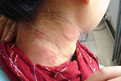 接触性皮炎留下的红斑 接触性皮炎的症状