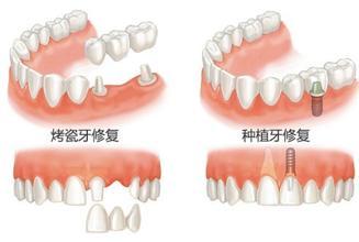 镶牙和烤瓷牙的区别 种植牙和烤瓷牙的区别