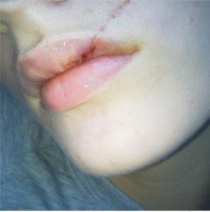 疤痕体质 疤痕体质 疤痕体质-简介，疤痕体质-疤痕分类