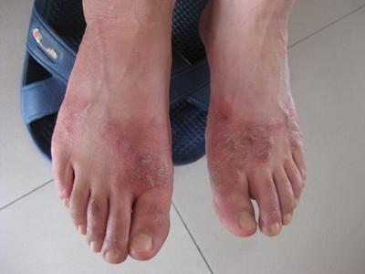 糜烂型脚气怎么治疗 糜烂型脚气 糜烂型脚气-治疗方法，糜烂型脚气-危害