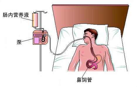 重症肌无力发病原因 重症急性胰腺炎 重症急性胰腺炎-发病原因，重症急性胰腺炎-发病