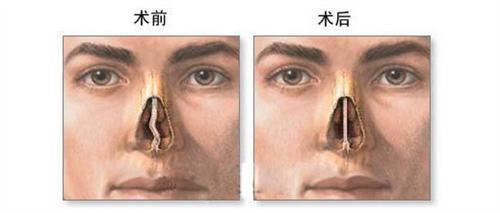 鼻中隔偏曲类型 鼻中隔偏曲 鼻中隔偏曲-疾病概述，鼻中隔偏曲-疾病类型