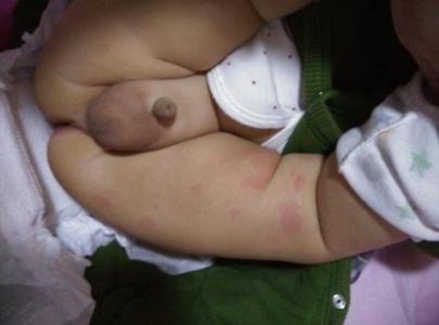 小孩洗澡后身上有红疹 宝宝身上起红疹怎么办