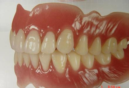 全口义齿多少钱 全口义齿 全口义齿-全口义齿介绍，全口义齿-全口义齿的表面结构
