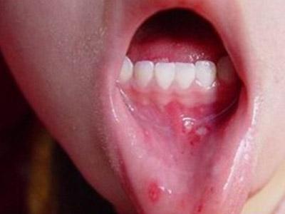 口腔溃疡吃什么水果 口腔溃疡怎么治最好