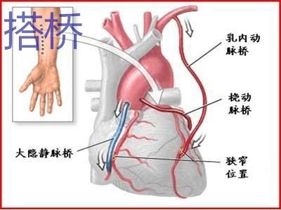 冠心病吃什么药最有效 冠心病如何治疗