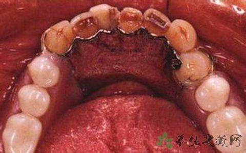 牙周脓肿 牙周脓肿 牙周脓肿-发病原因，牙周脓肿-病理改变