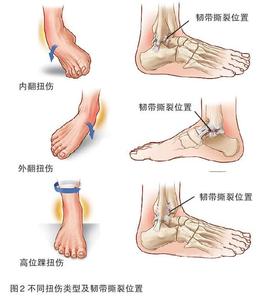 扭伤脚踝怎么处理 脚踝 脚踝-基本概述，脚踝-脚踝扭伤