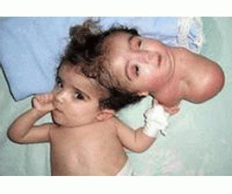 巴西双头婴儿 巴西双头婴儿 巴西双头婴儿-概述，巴西双头婴儿-意外发现