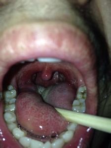 咽口水异物感怎么回事 咽部有异物感是怎么回事呢