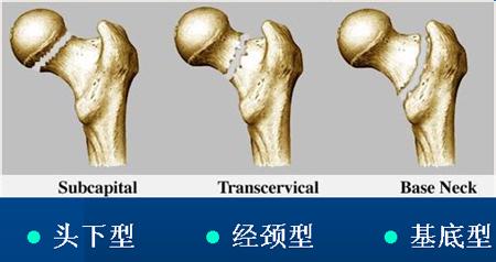 引起股骨头坏死的病因 股骨坏死 股骨坏死-症状，股骨坏死-病因