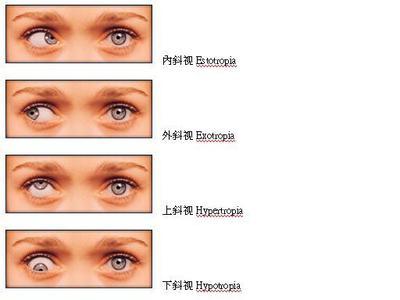 斜视病因 隐斜视 隐斜视-概述，隐斜视-病因