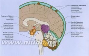 脑水肿分类 脑水肿 脑水肿-疾病概述，脑水肿-疾病分类