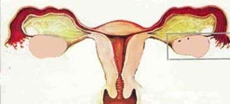 卵巢功能异常综合征 卵巢功能异常综合征 卵巢功能异常综合征-病因，卵巢功能异常综合