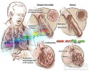 慢性阻塞性肺疾病 慢性阻塞性肺疾病 慢性阻塞性肺疾病-概述，慢性阻塞性肺疾病-病