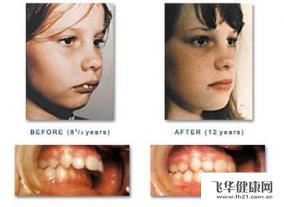 错颌畸形的病因 牙颌畸形 牙颌畸形-病因，牙颌畸形-检查诊断
