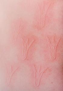 划痕荨麻疹症状 皮肤划痕症 皮肤划痕症-症状，皮肤划痕症-预防护理