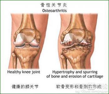 膝关节骨质增生病因 膝关节骨质增生 膝关节骨质增生-疾病概述，膝关节骨质增生-病因