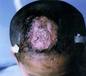 头癣的临床表现 头癣 头癣-病理原因，头癣-临床表现