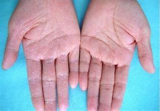 手足癣的临床表现 手足癣 手足癣-百科名片，手足癣-临床表现