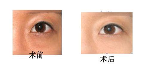 急性前列腺炎病因病理 眼球突出 眼球突出-病因病理，眼球突出-具体分类