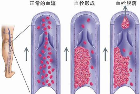 静脉血栓形成的原因 静脉血栓 静脉血栓-概述，静脉血栓-形成原因