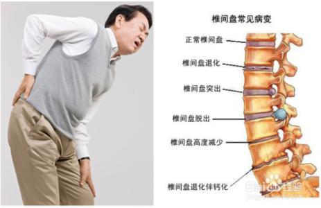腰疼的原因有哪些 腰疼的原因都有哪些?