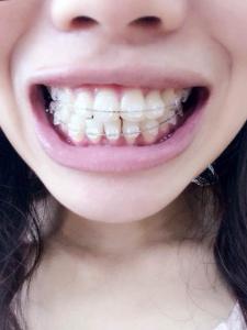 陶瓷牙套 优缺点 陶瓷牙套 陶瓷牙套-介绍，陶瓷牙套-优点