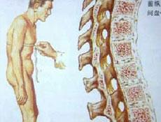 治强直脊柱炎骶髋关节 脊柱炎 脊柱炎-强直性脊柱炎症状，脊柱炎-骨骼关节以外的症状