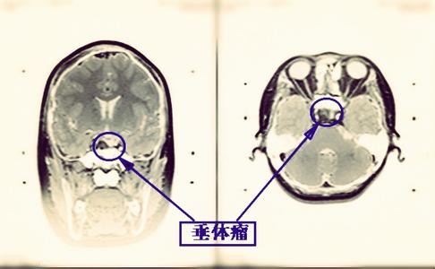概述和简介的区别 脑垂体瘤 脑垂体瘤-概述，脑垂体瘤-简介