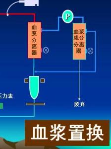 京东的发展历程概述 血浆置换 血浆置换-概述，血浆置换-发展历程