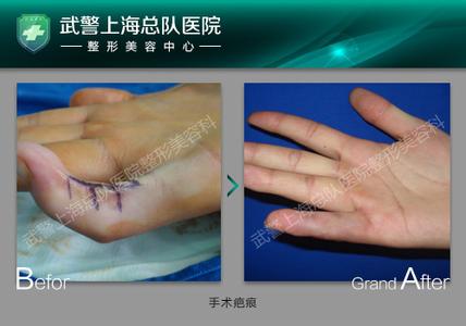 手术疤痕的形成 手术疤痕形成原与治疗