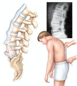 强直性脊柱炎的危害 强直性脊柱炎都有什么危害