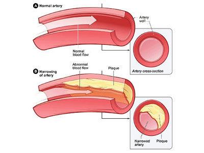 动脉硬化 动脉硬化 动脉硬化-概述，动脉硬化-类型